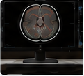 Medical contouring image on monitor